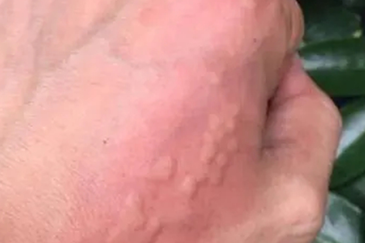 手上毛虫皮炎图