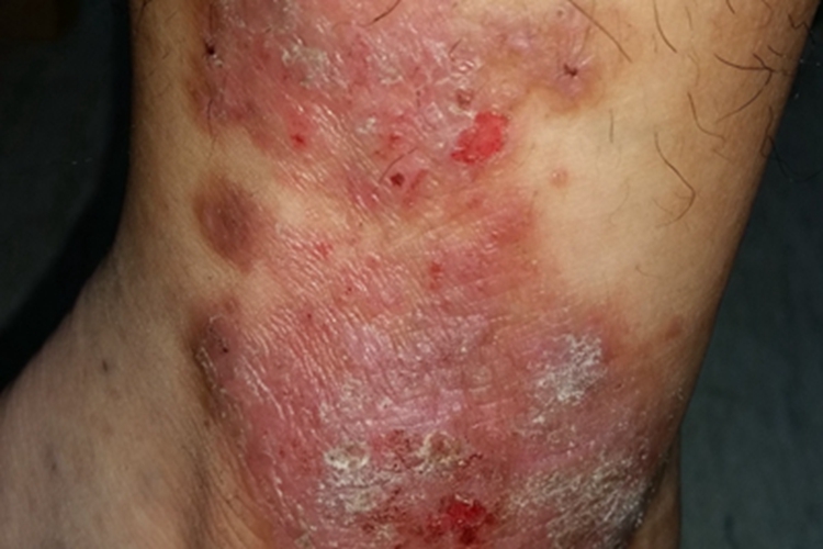 体癣脚踝症状图 体癣脚踝症状图