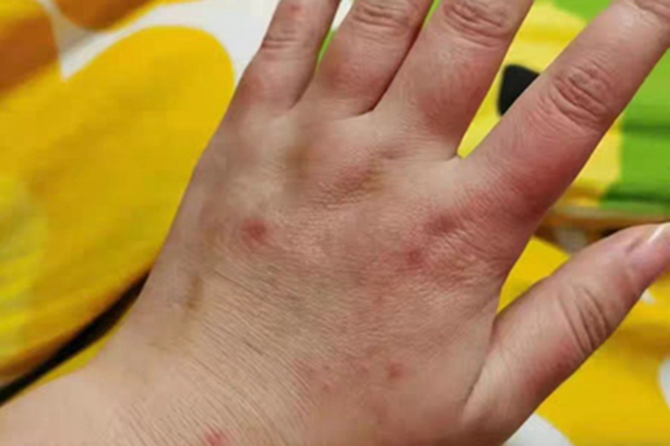 汗疱疹手背多个红色小疙瘩图 汗疱疹手背多个红色小疙瘩图