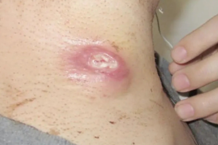 偶遇分枝杆菌感染颈部症状图