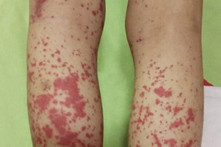 过敏性紫癜小腿后面都是红斑图 过敏性紫癜小腿后面都是红斑图