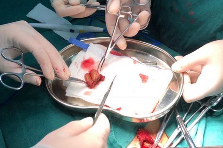 切除病变组织图