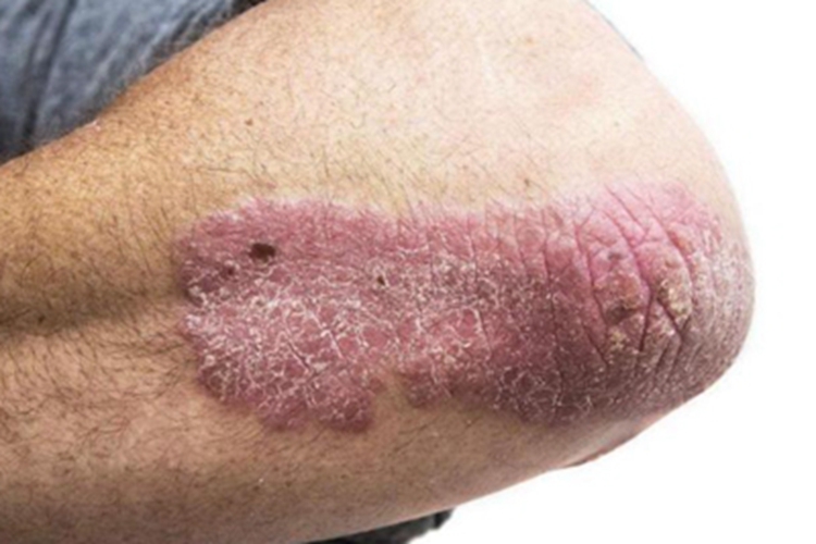 斑块型副银屑病症状图 斑块型副银屑病症状图