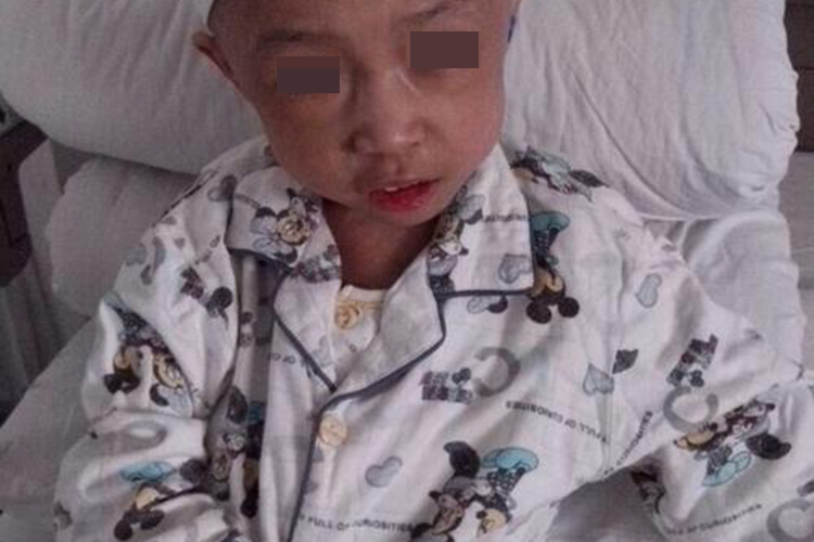 地中海贫血特殊面容图 地中海贫血特殊面容图