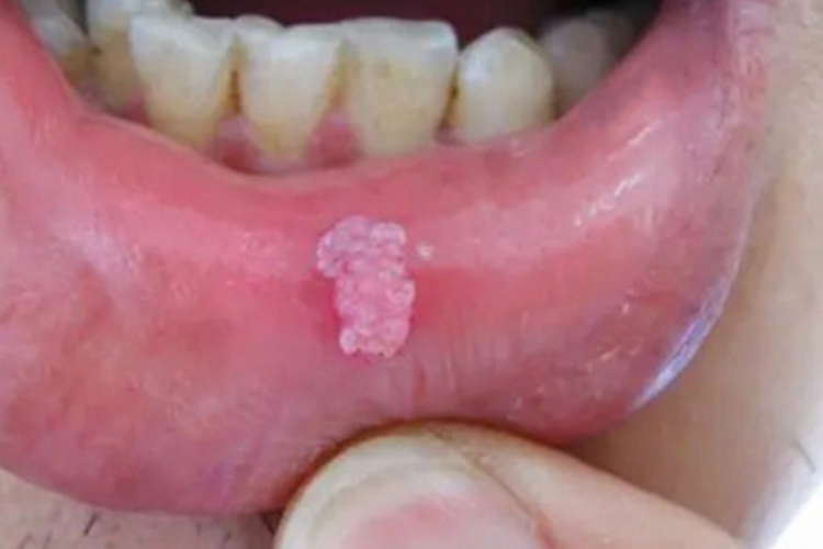 尖锐湿疣唇内侧症状图 尖锐湿疣唇内侧症状图