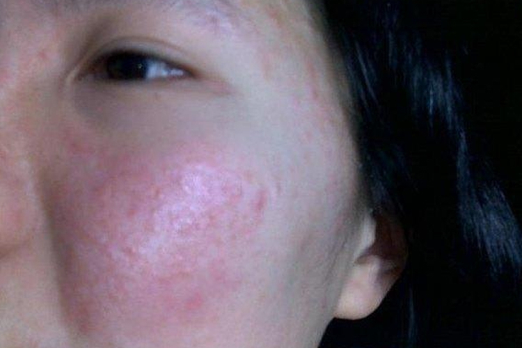 轻度化妆品过敏症状图