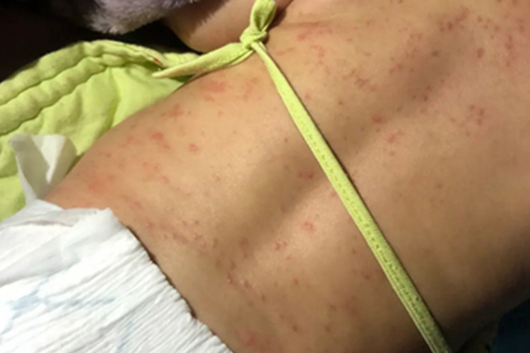 普通型猩红热背部红点图
