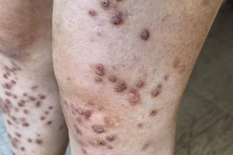 痒疹腿部结痂图