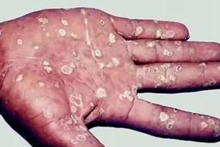 梅毒性白斑症状图