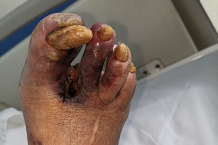 湿性坏疽脚趾肿胀图 湿性坏疽脚趾肿胀图