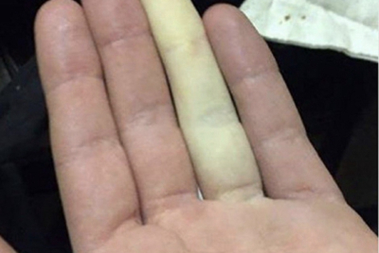 雷诺病无名指发白图