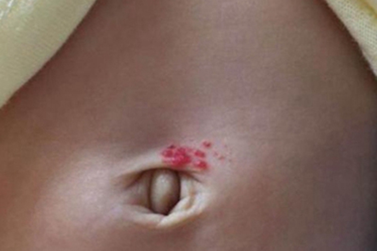 毛细血管瘤腹部红点图