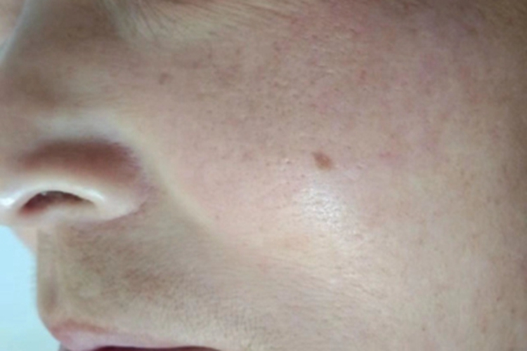 雀斑样痣面部长褐色斑图 雀斑样痣面部长褐色斑图