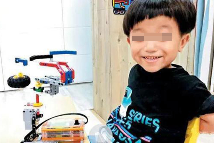 侏儒症儿童面部特征图