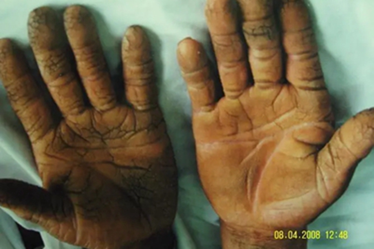 砷角化病皮肤颜色加深图