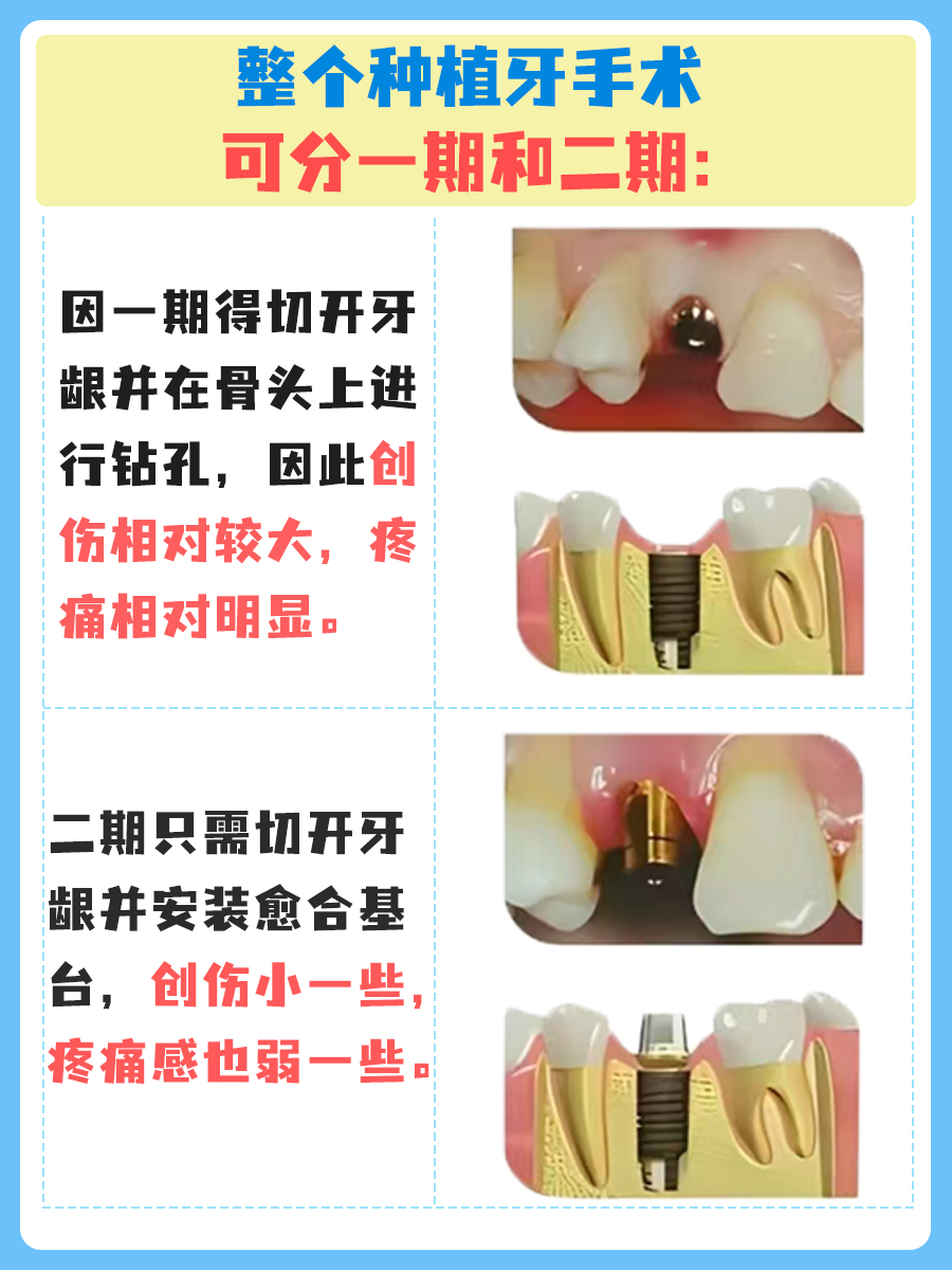 种牙二期比一期更痛吗？给想做种植牙的朋友一些建议