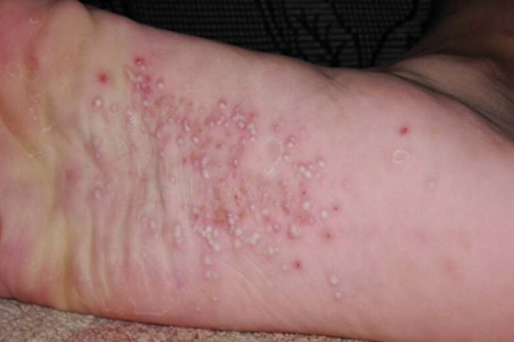 药物过敏性口炎脚底症状图