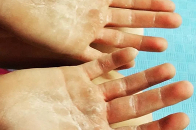 胼胝手掌变硬起皮图