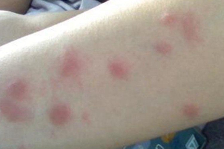 蚋叮咬引起的皮肤反应风团图
