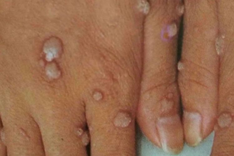 寻常疣样职业性疣赘手背丘疹图