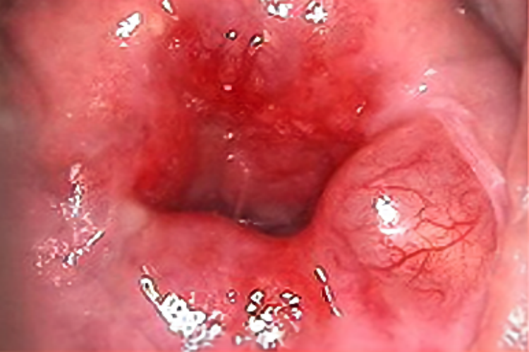 纳氏囊肿图 纳氏囊肿图