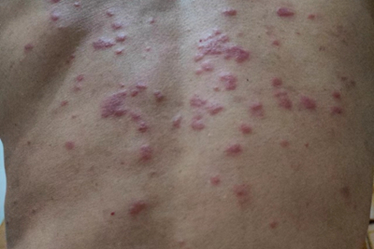 马拉色菌毛囊炎背部丘疹图