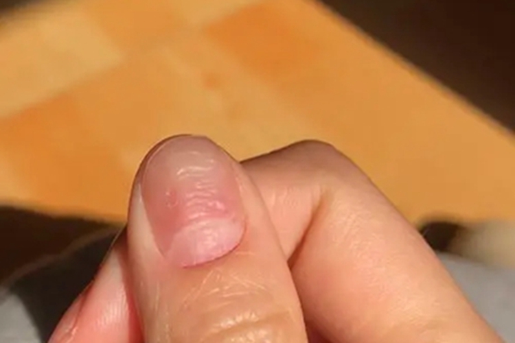 甲营养不良手指甲小坑图