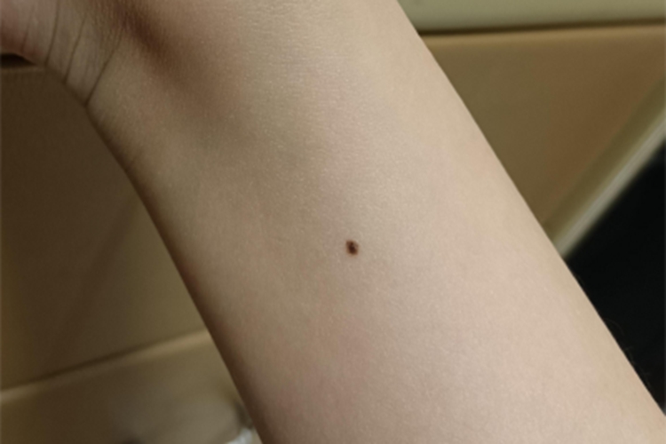 交界痣胳膊症状图