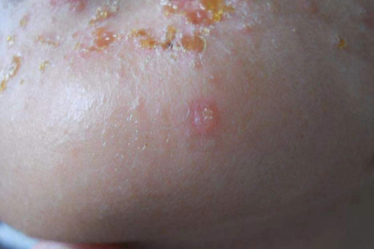 新生儿脓疱疮图