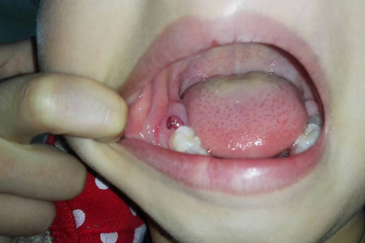 慢性牙龈炎有肉芽图