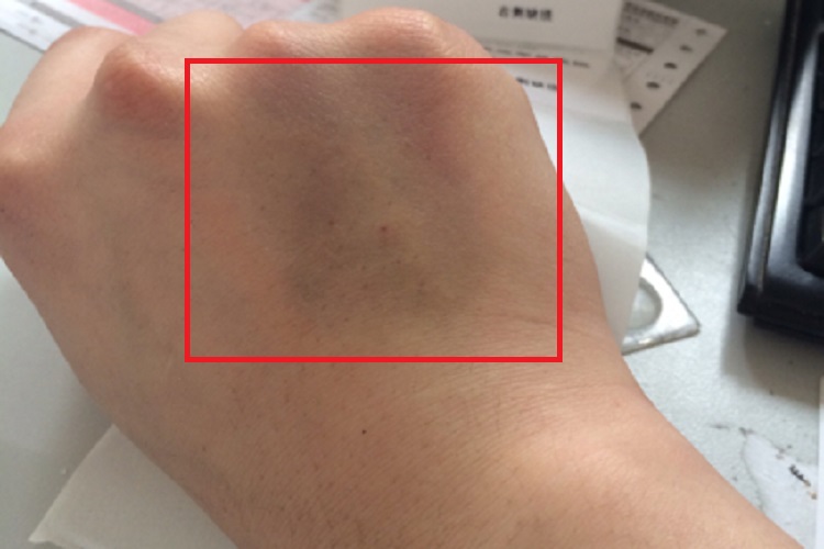 挫伤手背皮肤发青图 挫伤手背皮肤发青图