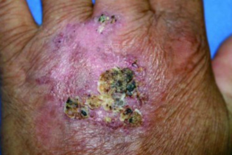 着色芽生菌病手部症状图 着色芽生菌病手部症状图