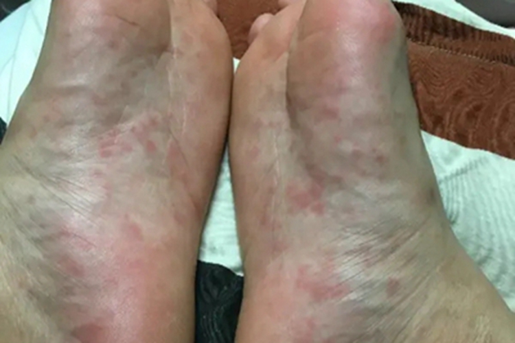 药物过敏性口炎脚底症状图