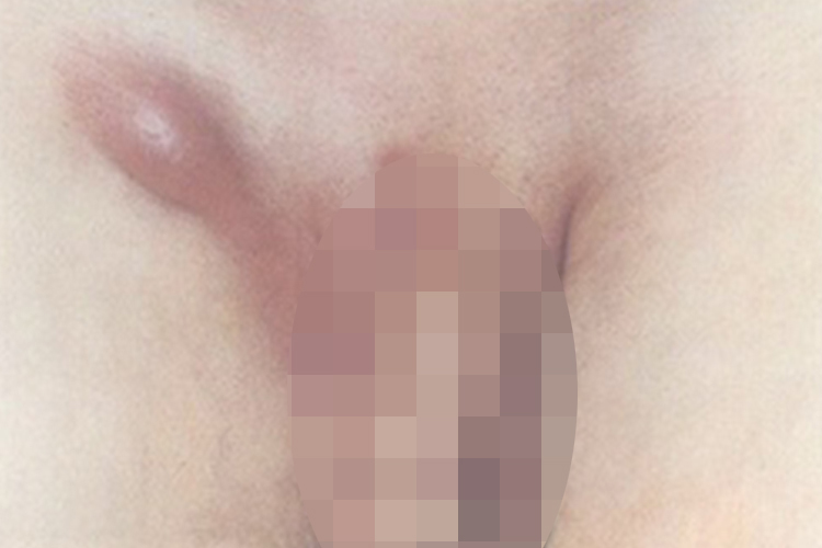 男性腹股沟淋巴结肿大图