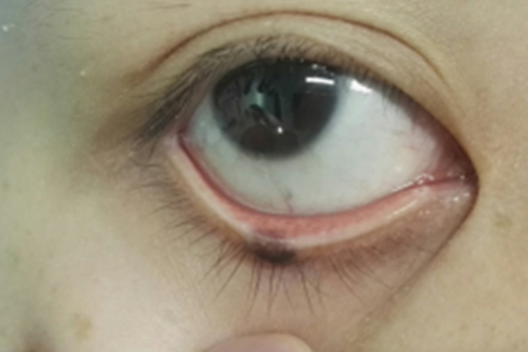 眼睑蓝痣眼睑症状图片