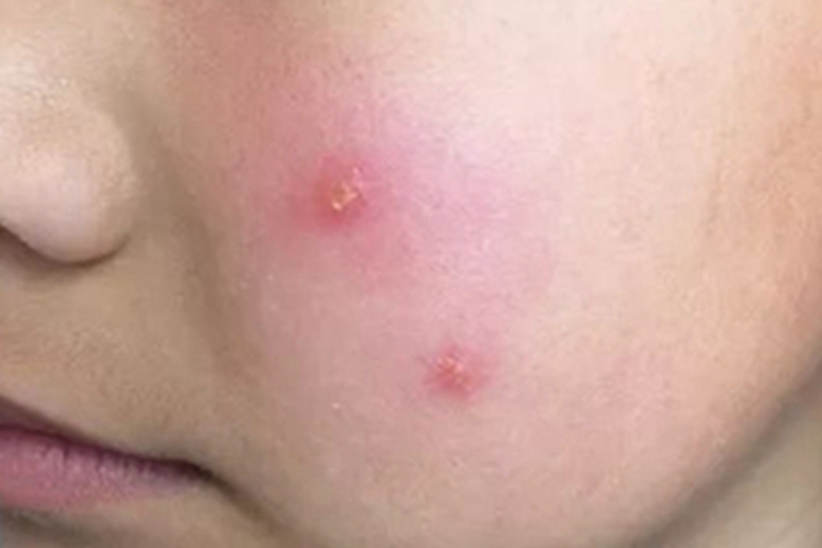 寒冷性多形红斑面部斑图