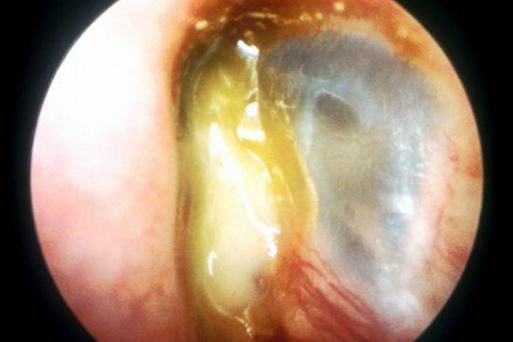 慢性中耳炎黏脓性分泌物图 慢性中耳炎黏脓性分泌物图