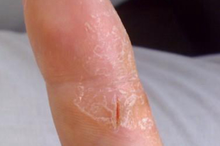 甲状腺功能减退症手指脱皮图