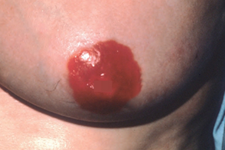 乳房Paget病乳晕红肿图 乳房Paget病乳晕红肿图