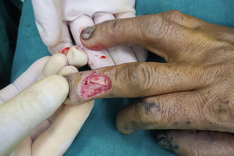 中指伸肌腱断裂图 中指伸肌腱断裂图