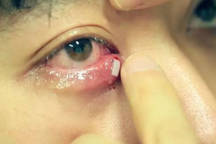 眶蜂窝织炎皮肤有渗液图