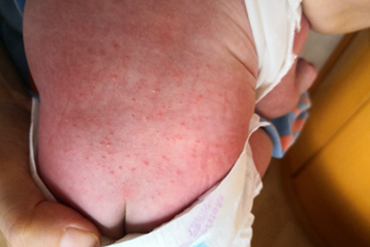 红痱臀部症状图 红痱臀部症状图