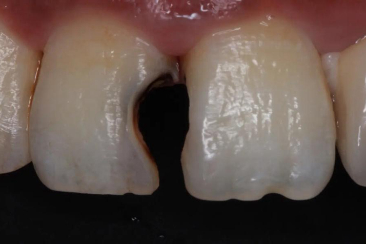 门牙龋病图 门牙龋病图