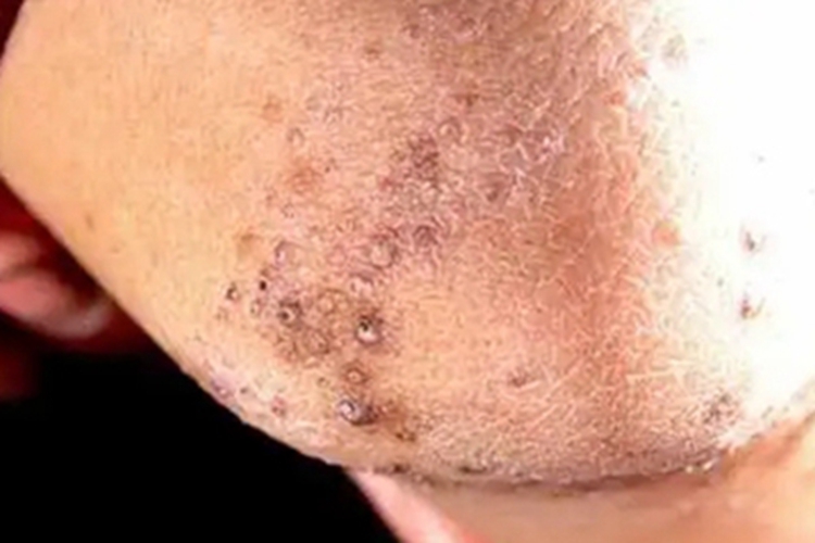 毛囊与毛囊旁角化过度症肘部结痂图 毛囊与毛囊旁角化过度症肘部结痂图