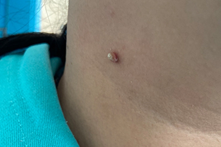 寻常疣颈部小疙瘩图