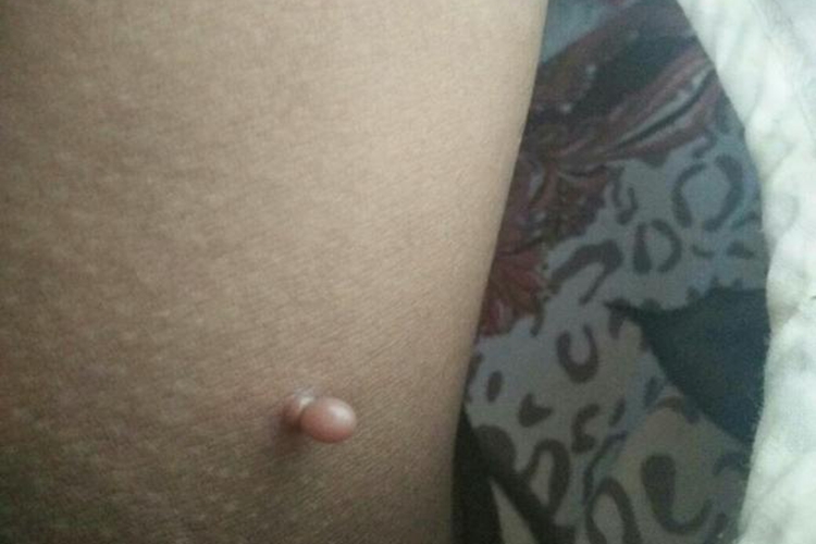 大腿内侧软纤维瘤图