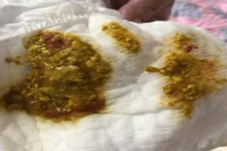 婴儿牛奶蛋白过敏图 婴儿牛奶蛋白过敏图