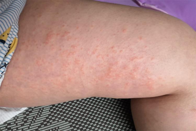 疣状肢端角化病大腿大疙瘩图 疣状肢端角化病大腿大疙瘩图