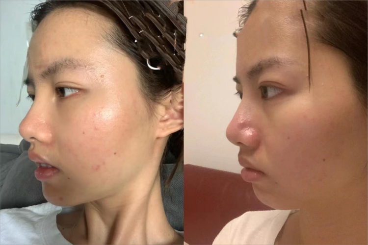 自体脂肪填充山根前后对比图