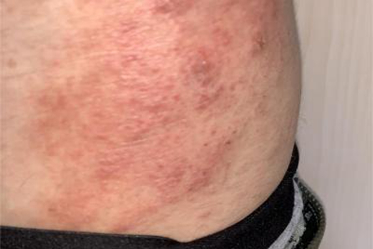 慢性湿疹腹部斑图 慢性湿疹腹部斑图